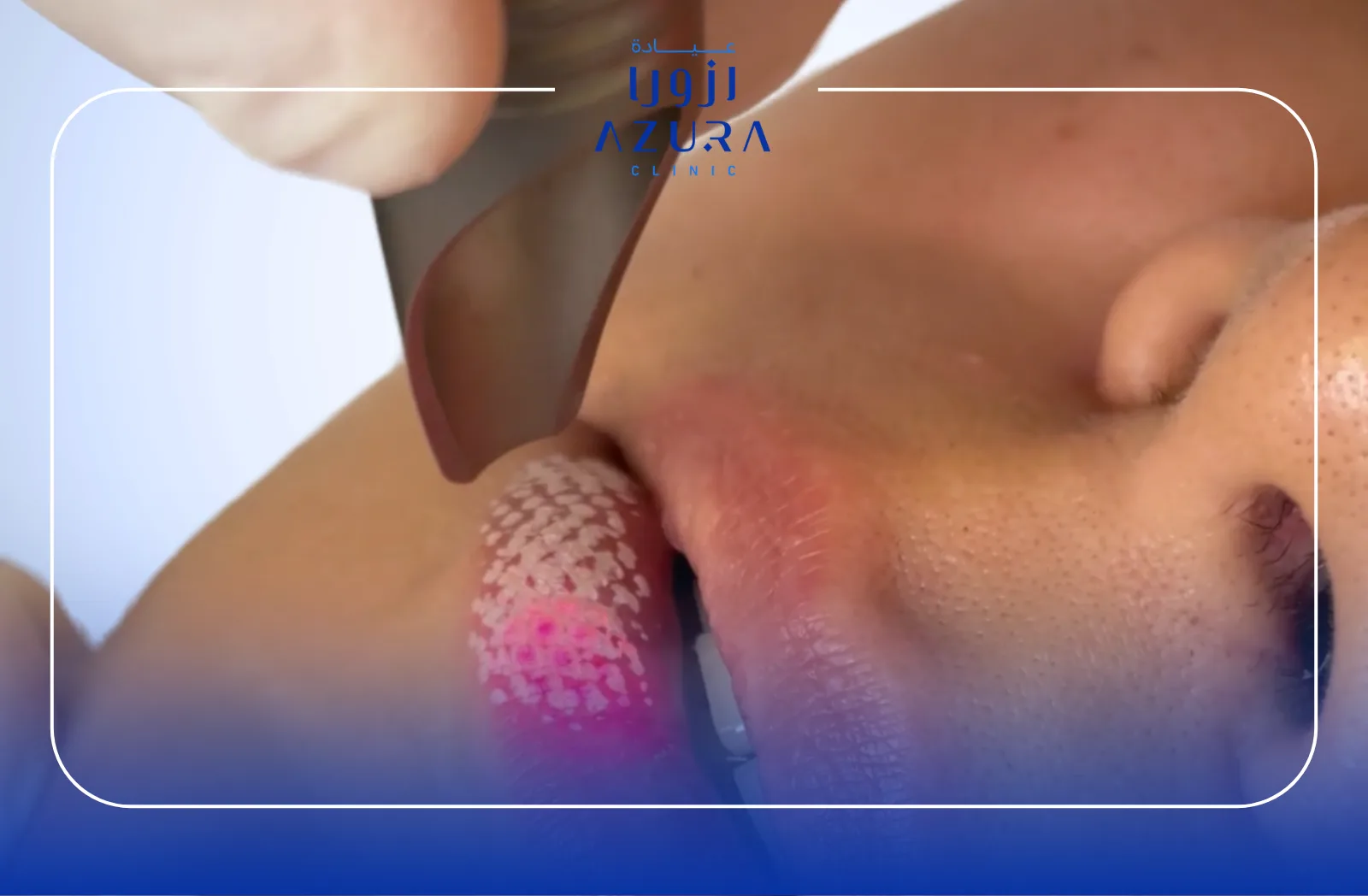 5 Key Advantages of LipLase by Fotona SP Dynamis: The Exquisite Non-Surgical Lip Rejuvenation