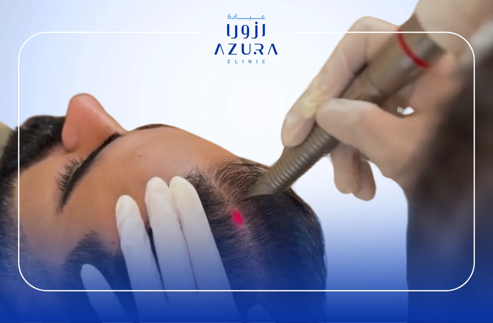 5 Powerful Benefits of HAIRestart by Fotona SP Dynamis: Transform Your Hair Growth Today