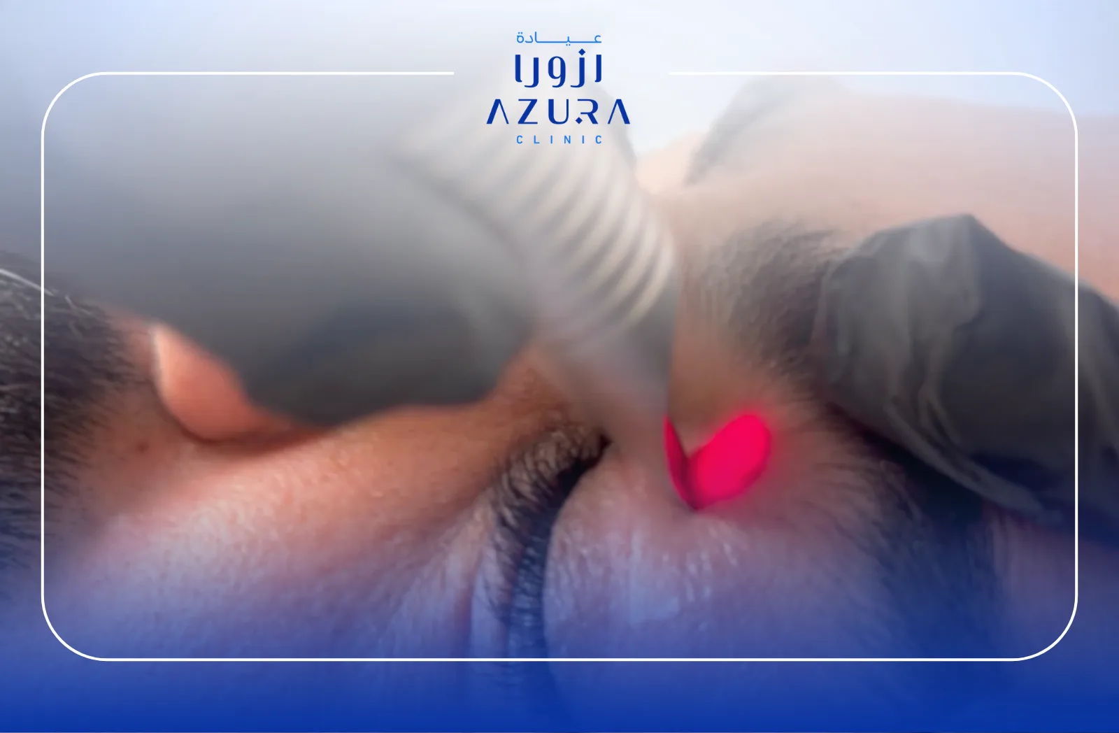 Ultimate SmoothEye by Fotona SP Dynamis: 5 Key Benefits of the Groundbreaking Non-Surgical Eye Lift