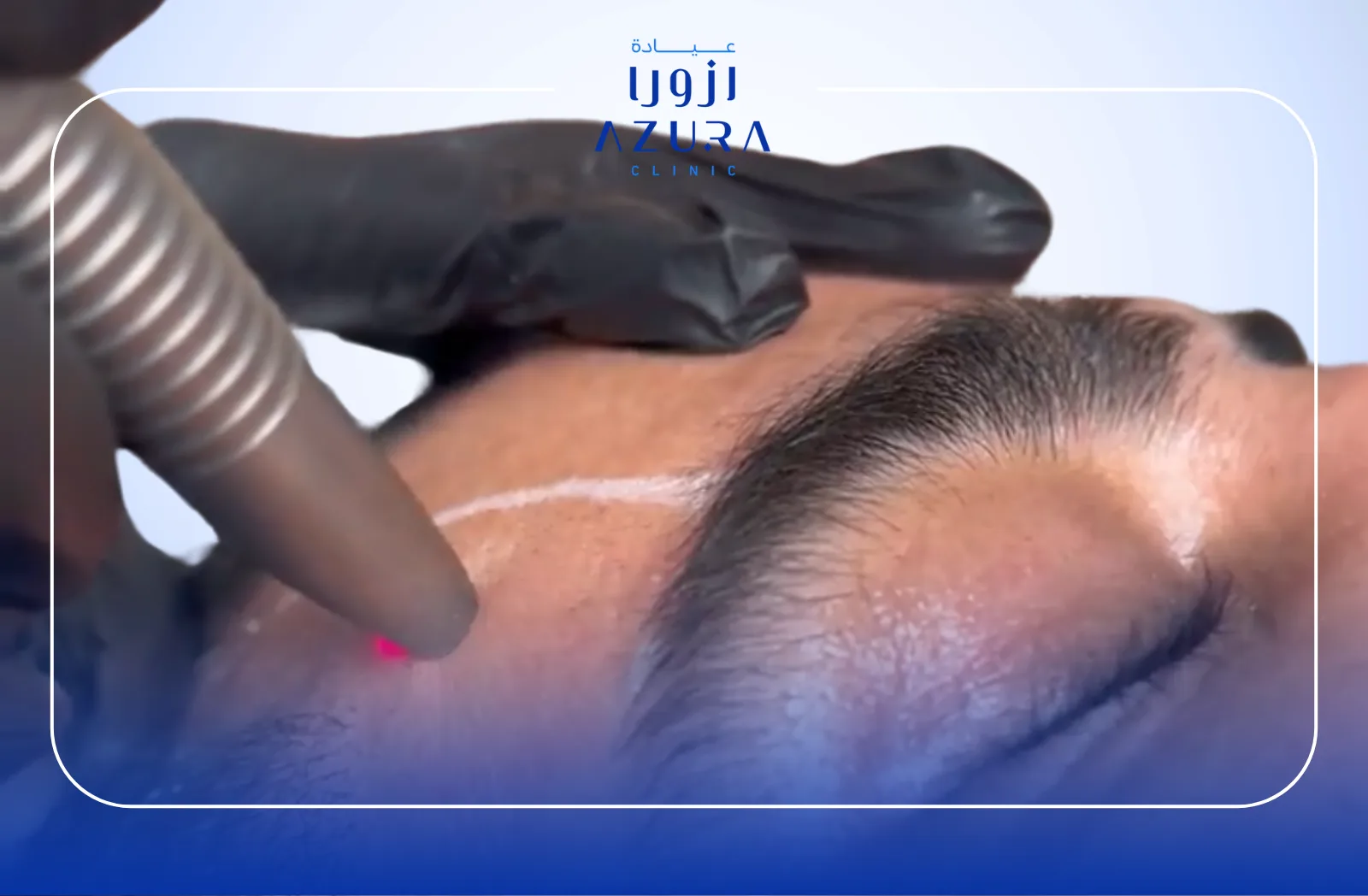 VectorLift by Fotona SP Dynamis: 5 Key Benefits of the Astounding Non-Surgical Face Lift