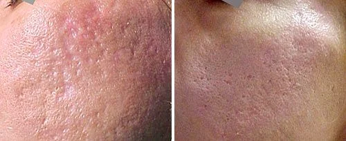 acne scar removal fotona sp dynamis