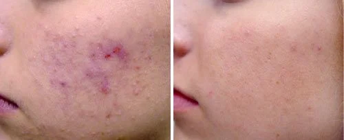 acne scar before and after fotona sp dynamis