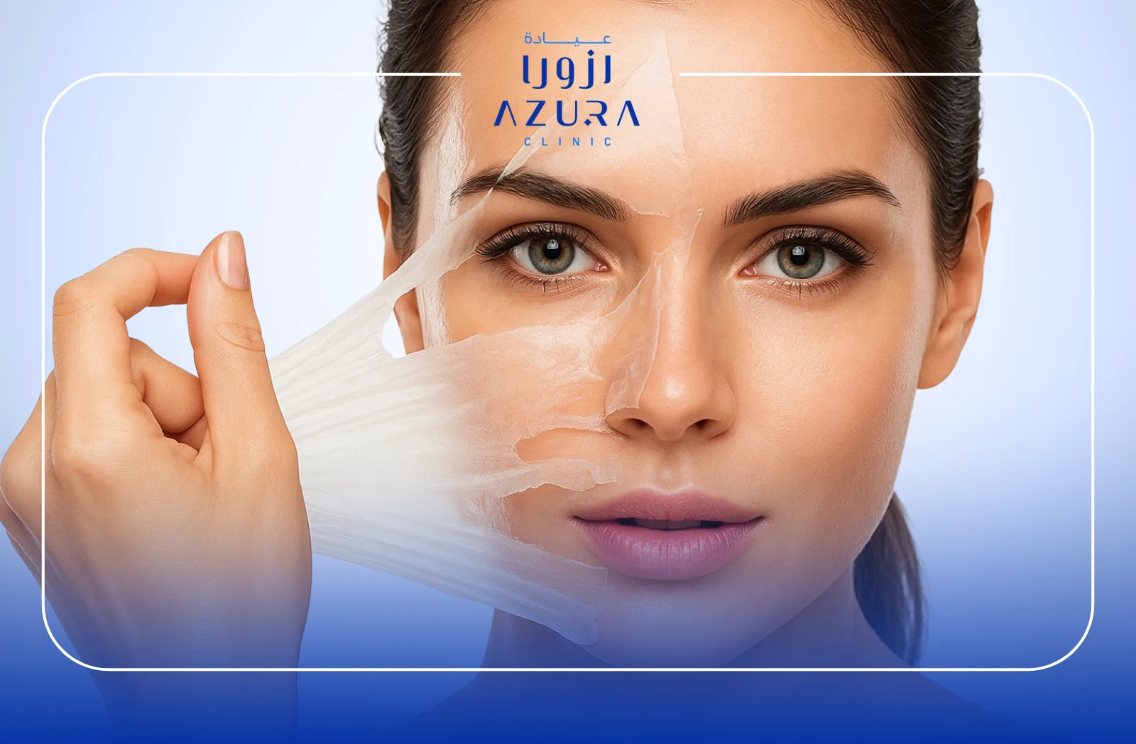 Chemical Peeling 1 Chemical Peeling