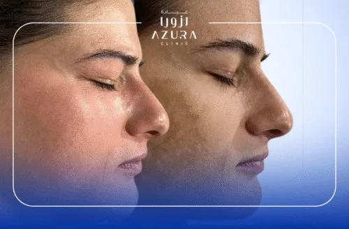 Face Brightening with Q-Switched Laser