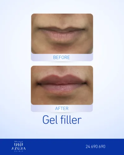 Before and after gel filler lip treatment showing increased lip volume and definition at Azura Clinic Muscat