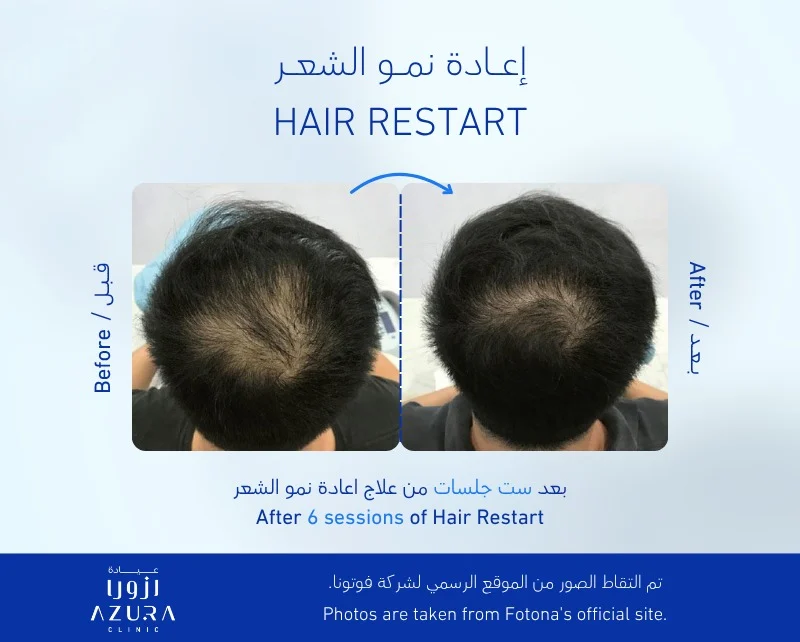 Fotona sp dynamis hair restart before and after
