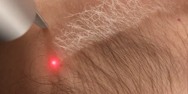 Hair Bleaching (Q-Switched Laser)