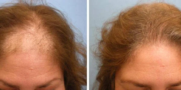 Hair Loss Treatment