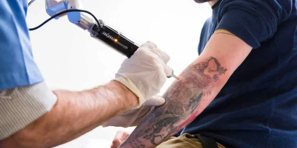 Tattoo Removal (Q-Switched Laser)