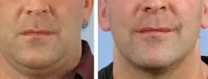 double chin treatment