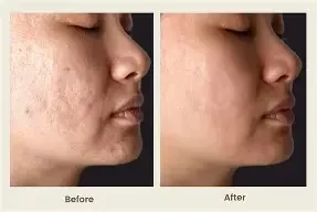 Exosome+Stem Cell Therapy for Skin