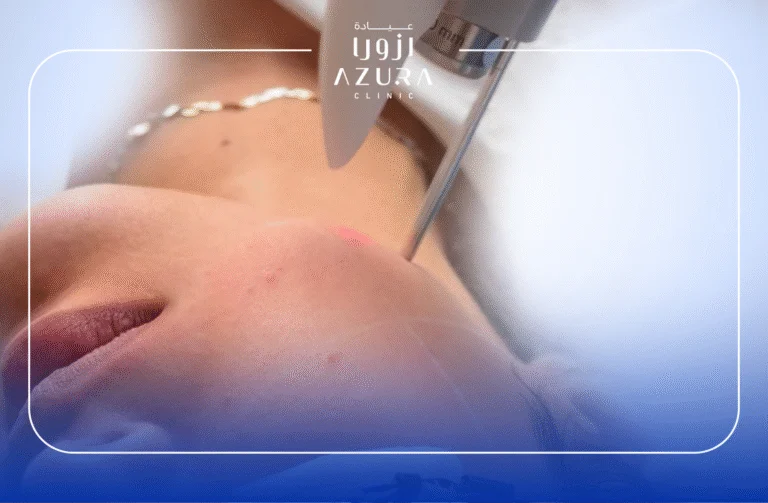 Fotona 4D non-surgical laser facelift treatment for skin tightening and rejuvenation at Azura Clinic Muscat Oman