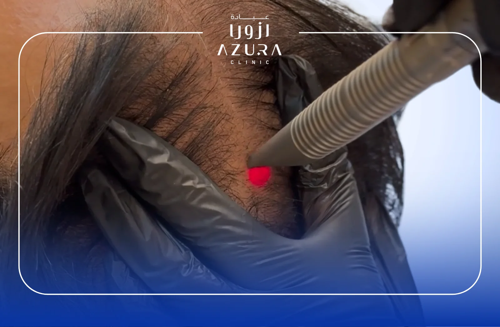 4 Powerful Combine Hair Treatments that Actually Work: PRP, Biotin, Mesotherapy & Fotona