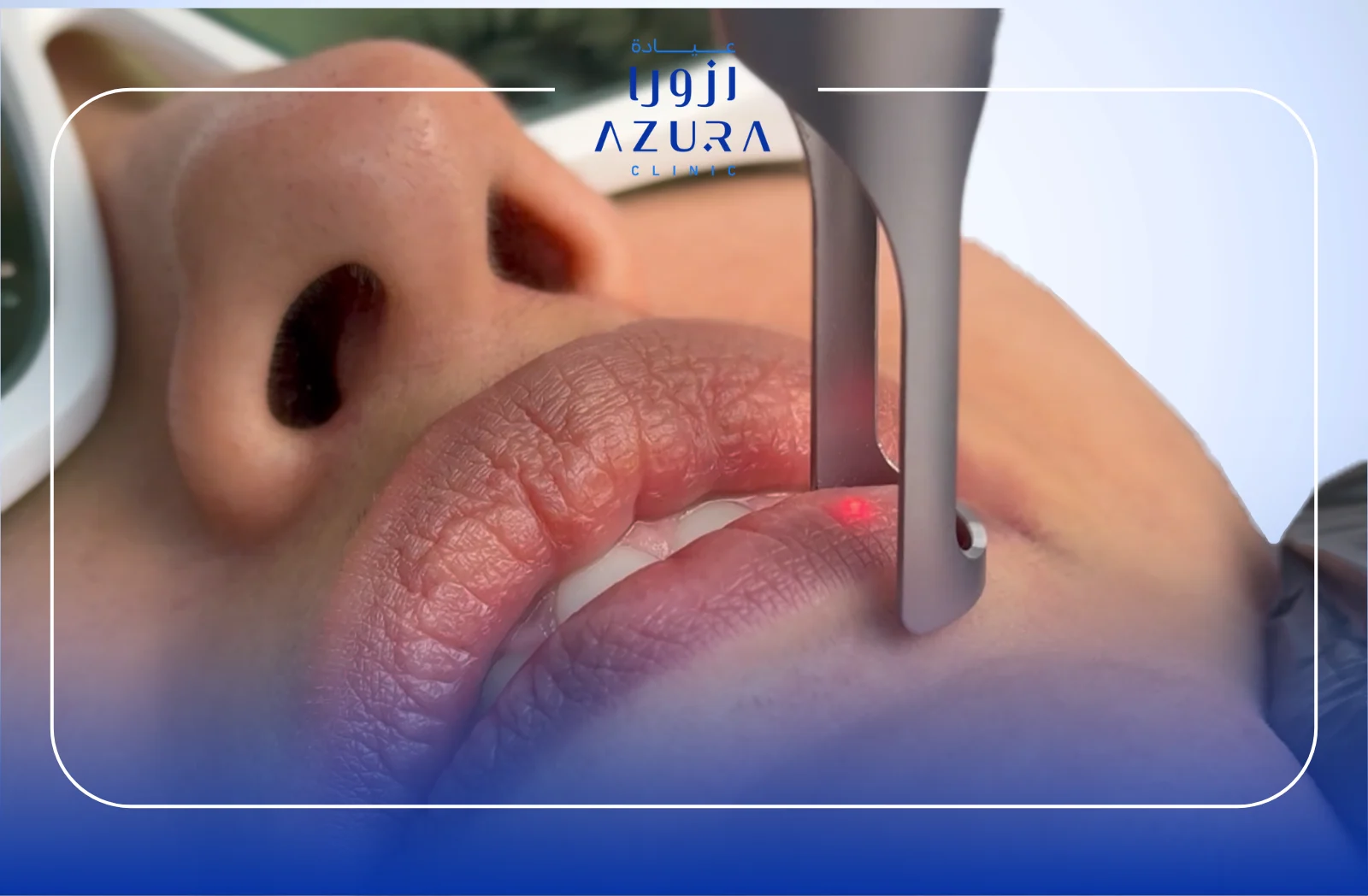 7 Powerful Benefits of Lip Glowing with Q-Switch Laser Treatment