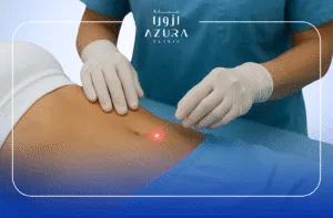 Abdominal Lipolysis 4 Abdominal Lipolysis