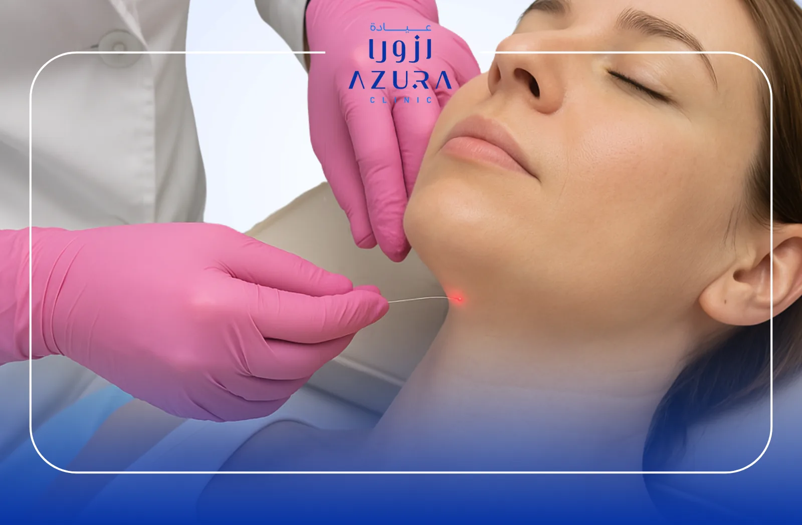 Endolift for Double Chin