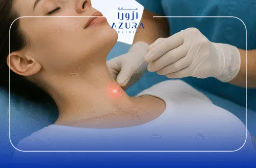 Endolift for Neck