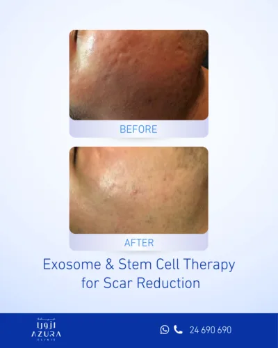 Before and after acne scar treatment on the cheek using exosome and stem cell therapy at Azura Clinic Muscat