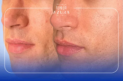 Exosome+Stemcell Therapy(Reduce Scars)