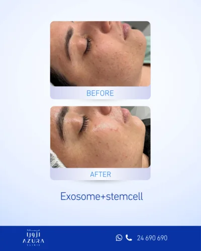 Exosome + Stem Cell Treatment at Azura Clinic Muscat to support skin rejuvenation, hydration, texture, and radiance.