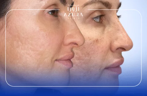 Face Glowing with Exosome+stemcell