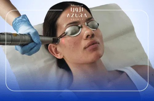 Face Glowing with Q-Switched Laser