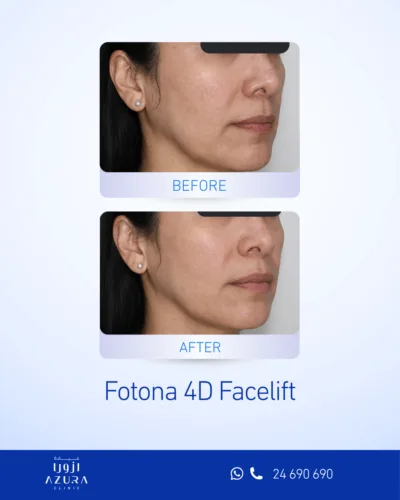 Before and after Fotona 4D Facelift showing improved jawline definition and skin firmness on the lower face and neck
