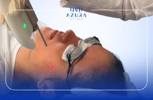 Fotona Active Acne treatment