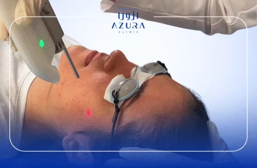 Fotona Active Acne treatment