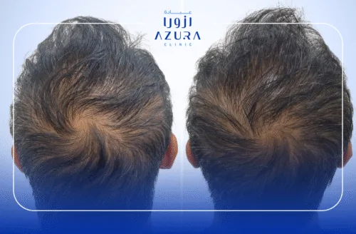 Fotona Hair Restart and Mesotherapy