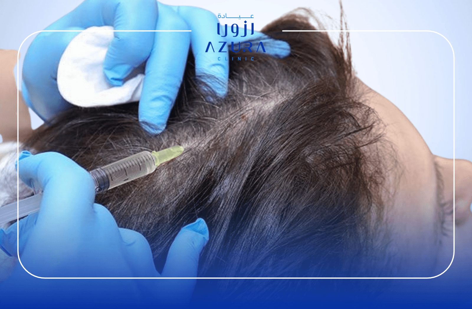 Mesotherapy injection for hair loss and scalp treatment at Azura Clinic