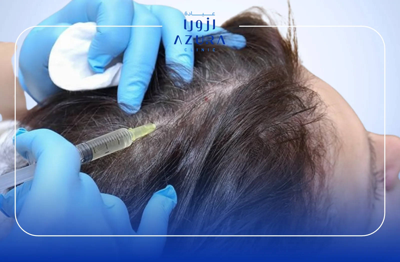 Mesotherapy injection for hair loss and scalp treatment at Azura Clinic