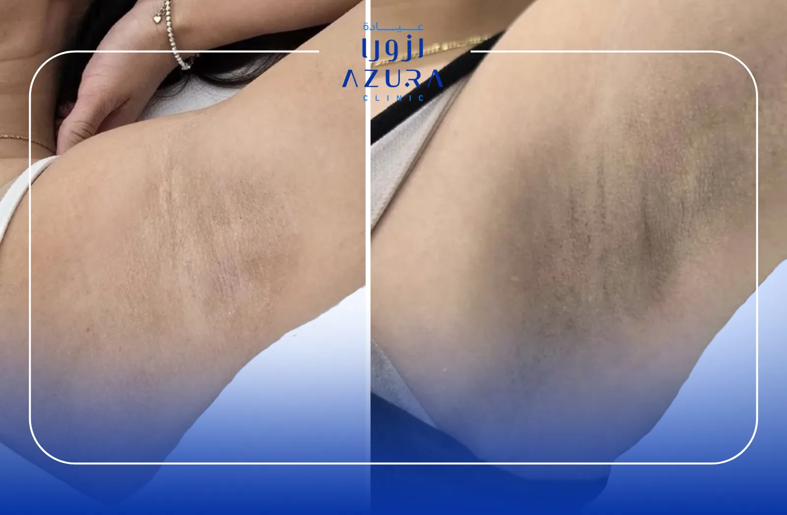 Fotona Underarms Whitening