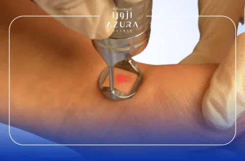 Fotona for Reduce Scar