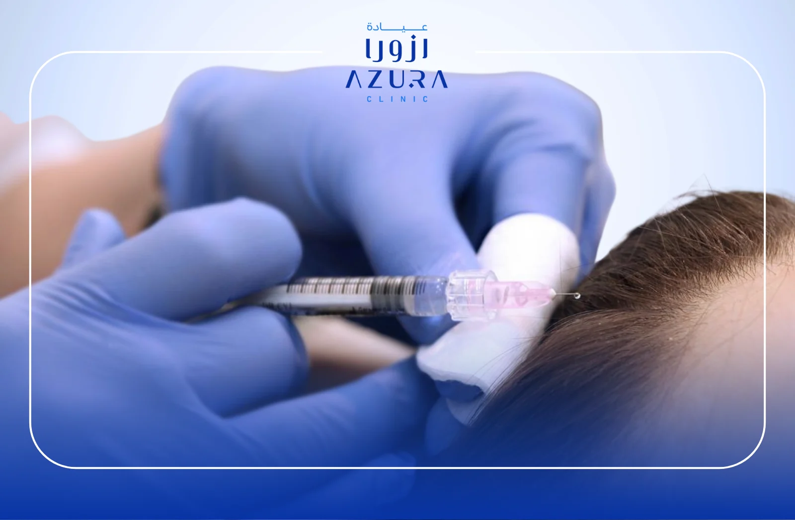 Hair Filler: 7 Amazing Benefits of This Breakthrough Hair Loss Solution 1 Hair Filler: 7 Amazing Benefits of This Breakthrough Hair Loss Solution