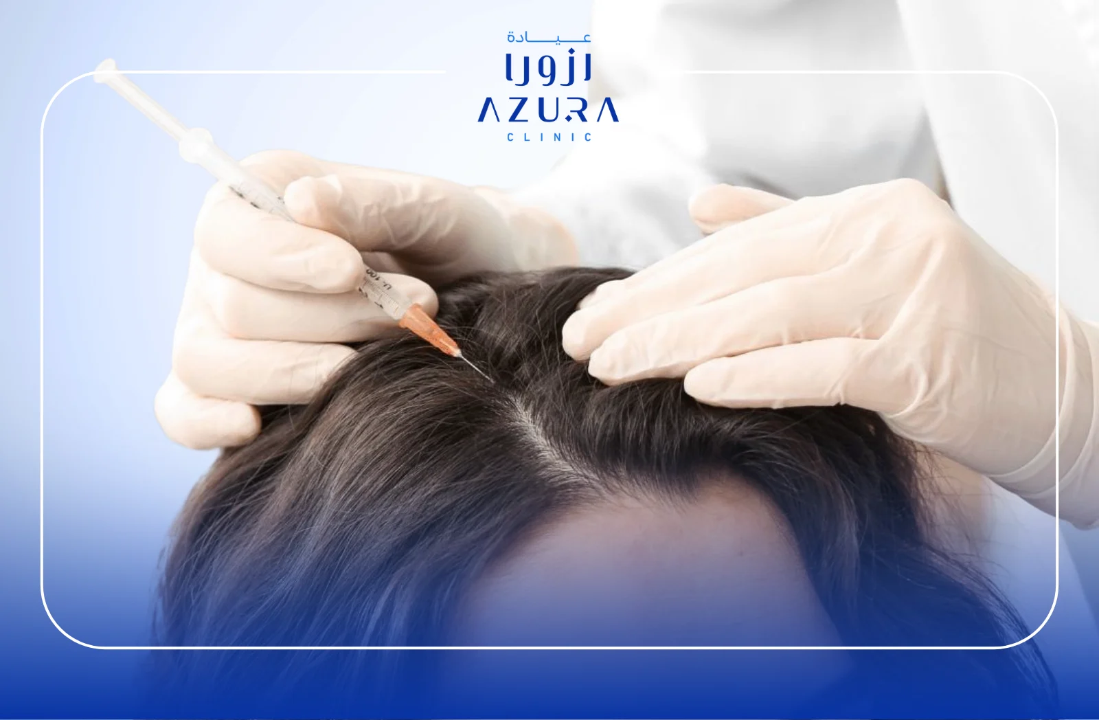 Hair Mesotherapy: 7 Powerful Benefits of This Hair Loss Treatment You Need to Know