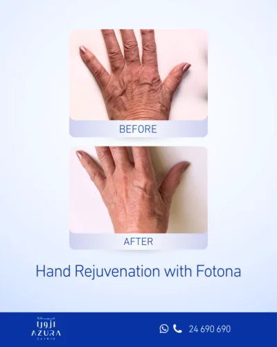 Before and after Fotona hand rejuvenation showing smoother, firmer skin on the back of the hand at Azura Clinic Muscat