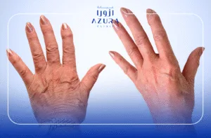Hand Rejuvenation with Fotona