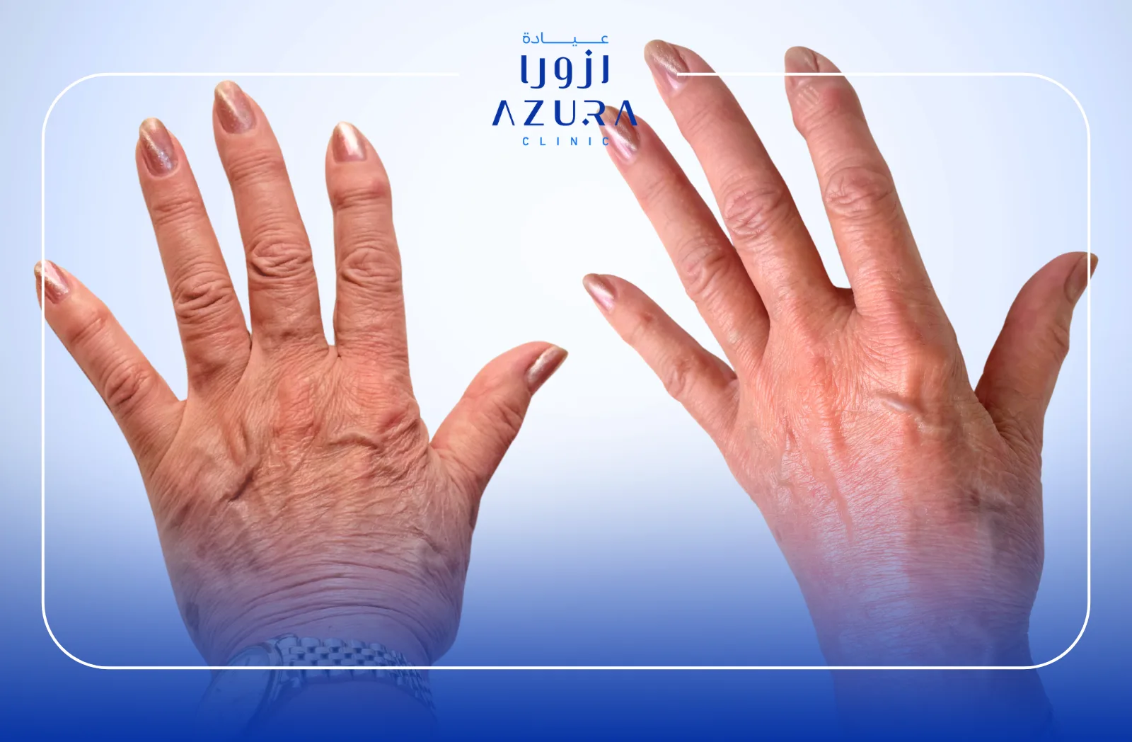 Hand Rejuvenation with Fotona