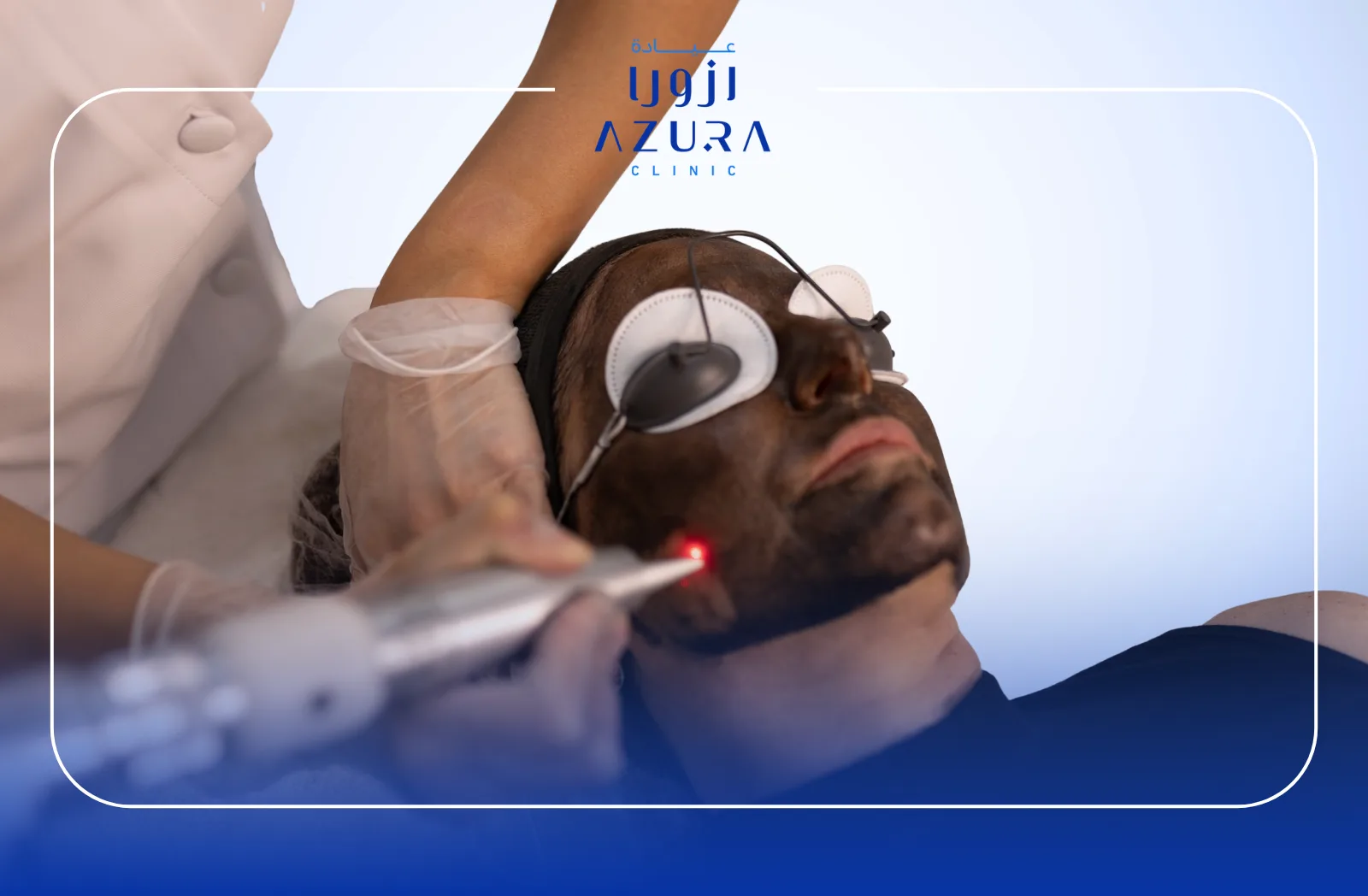 Hollywood Carbon Peeling