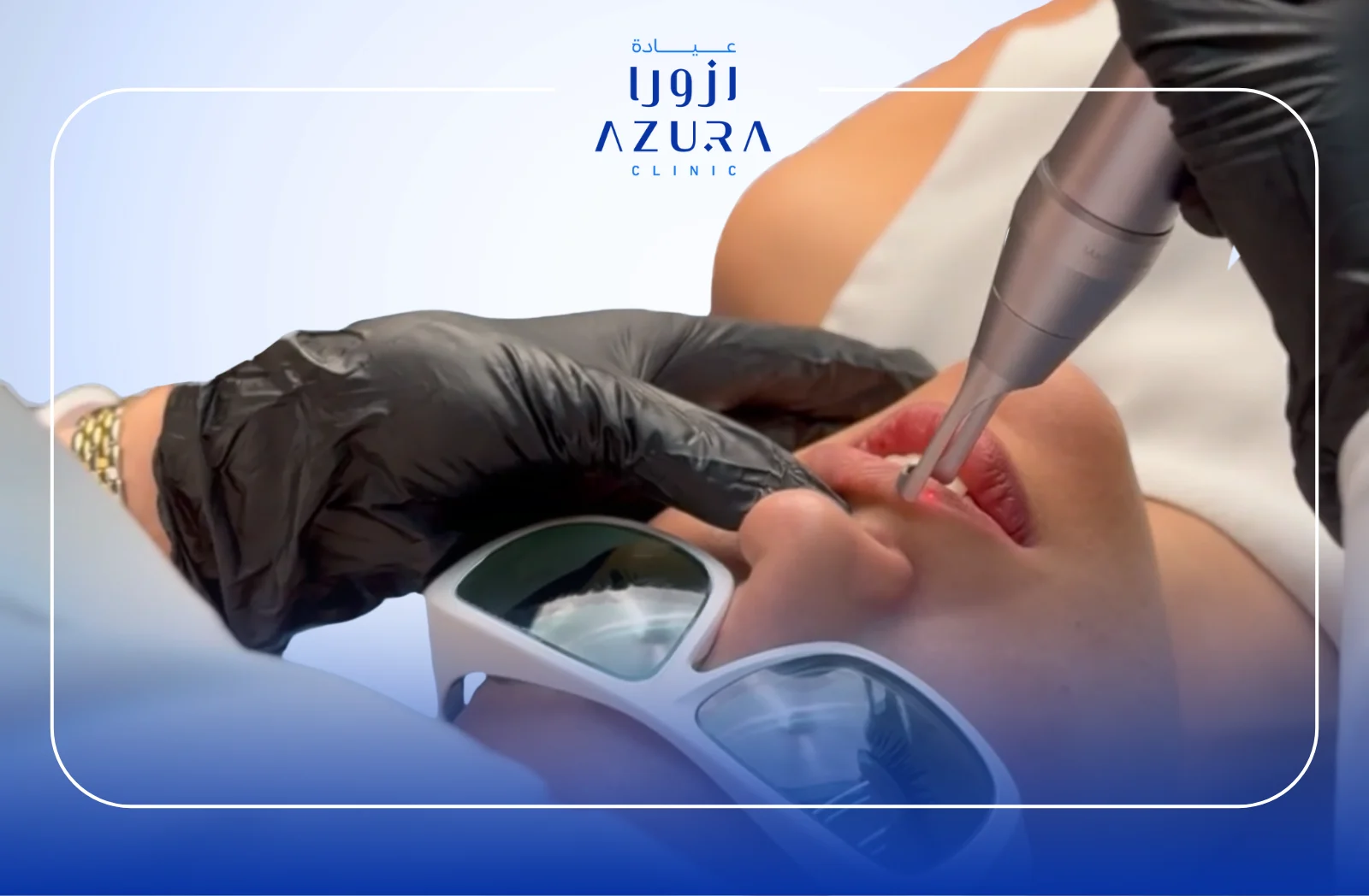 How to Get Glowing Lips with Lip Laser Treatment [2025 Guide]