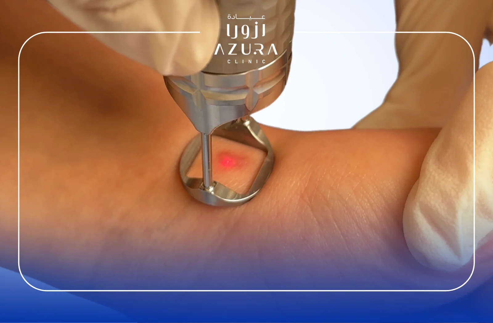 Instantly Improve Skin: Reduce Scars with Fotona Fractional Laser in 2025