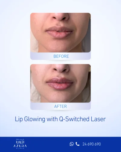 Before and after Q-Switch laser lip pinkening treatment showing fuller, more even lip colour at Azura Clinic Muscat
