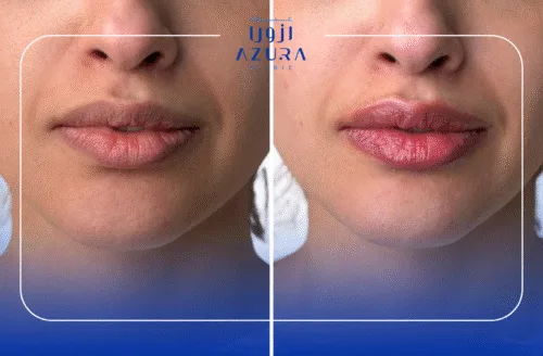 Lip Glowing with Q-Switched Laser