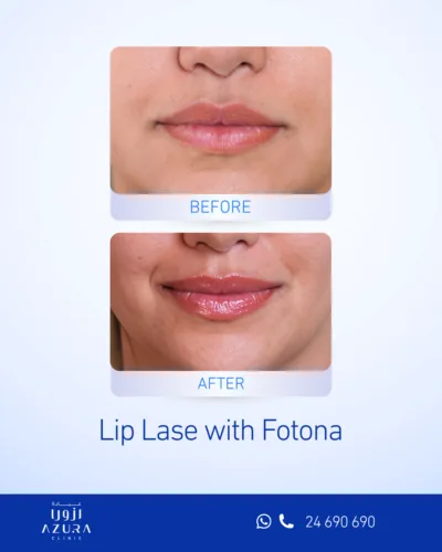 Before and after Fotona LipLase lip enhancement at Azura Clinic, showing fuller, more defined lips