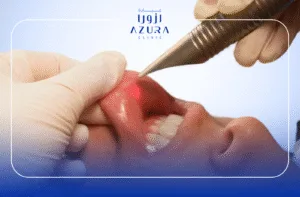 Lip Lase with Fotona 3 Lip Lase with Fotona