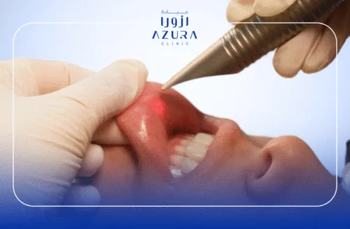 Lip Lase with Fotona