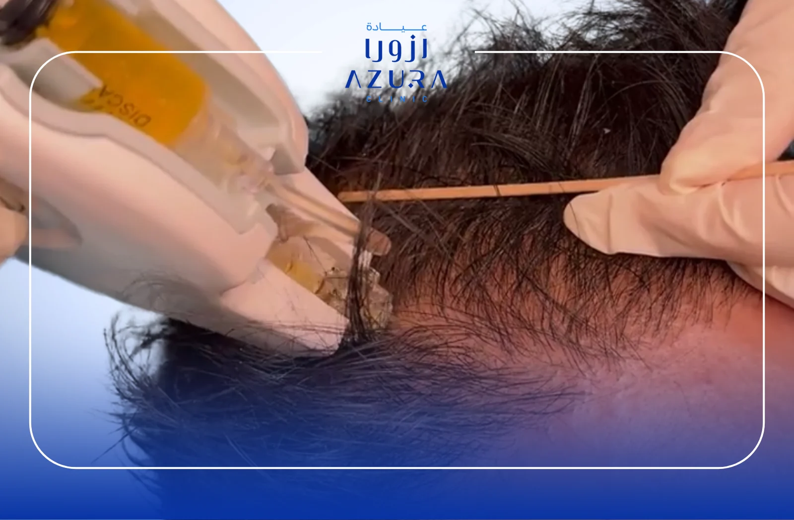 Mesogun Treatment for Hair: 7 Powerful Reasons It Works for Hair Loss