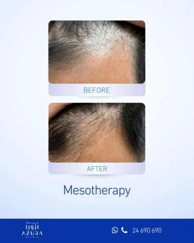 Before and after mesotherapy for hair loss at the frontal scalp, showing visibly denser hair coverage at Azura Clinic