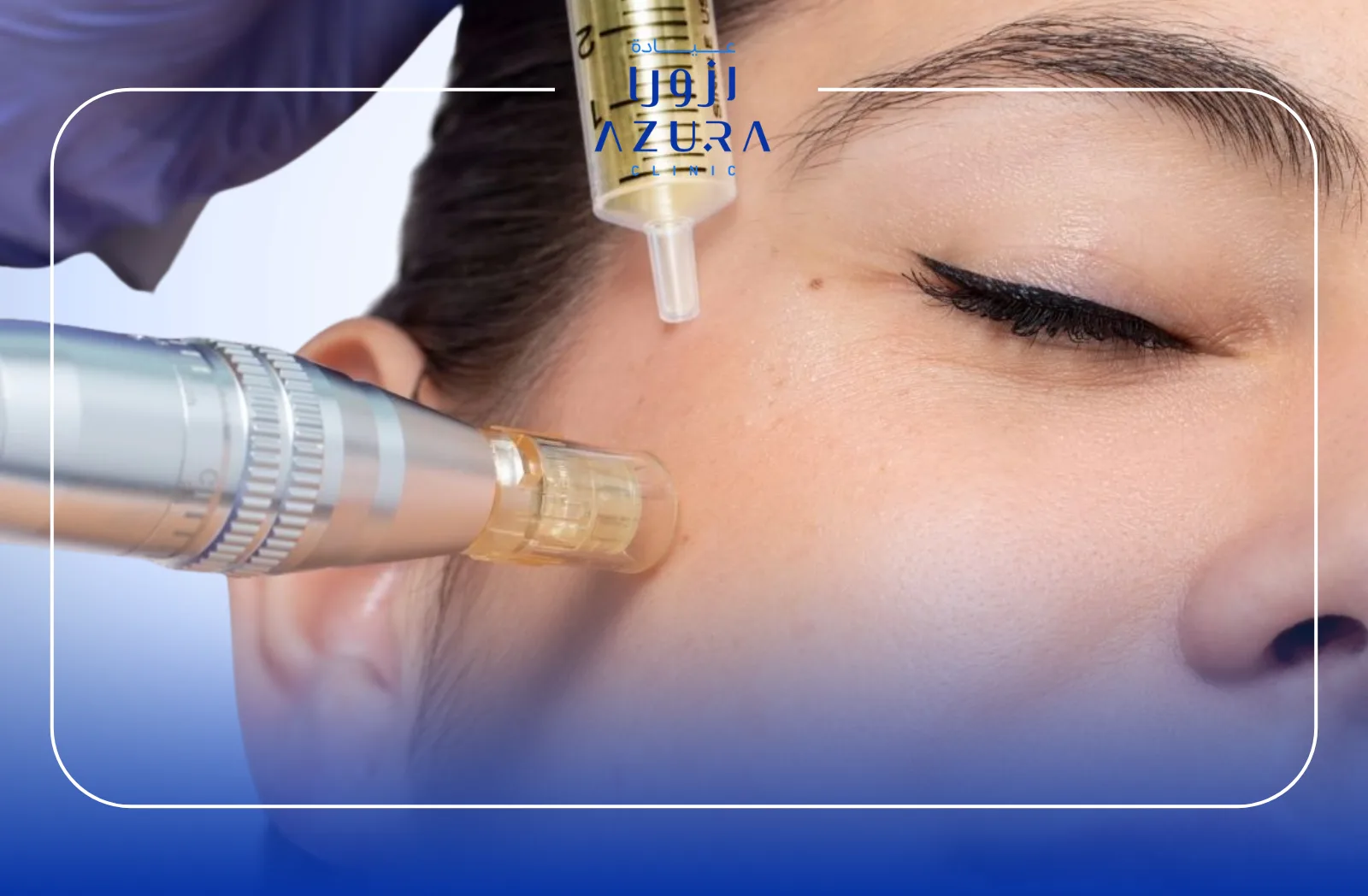 Microneedling with PRP Therapy